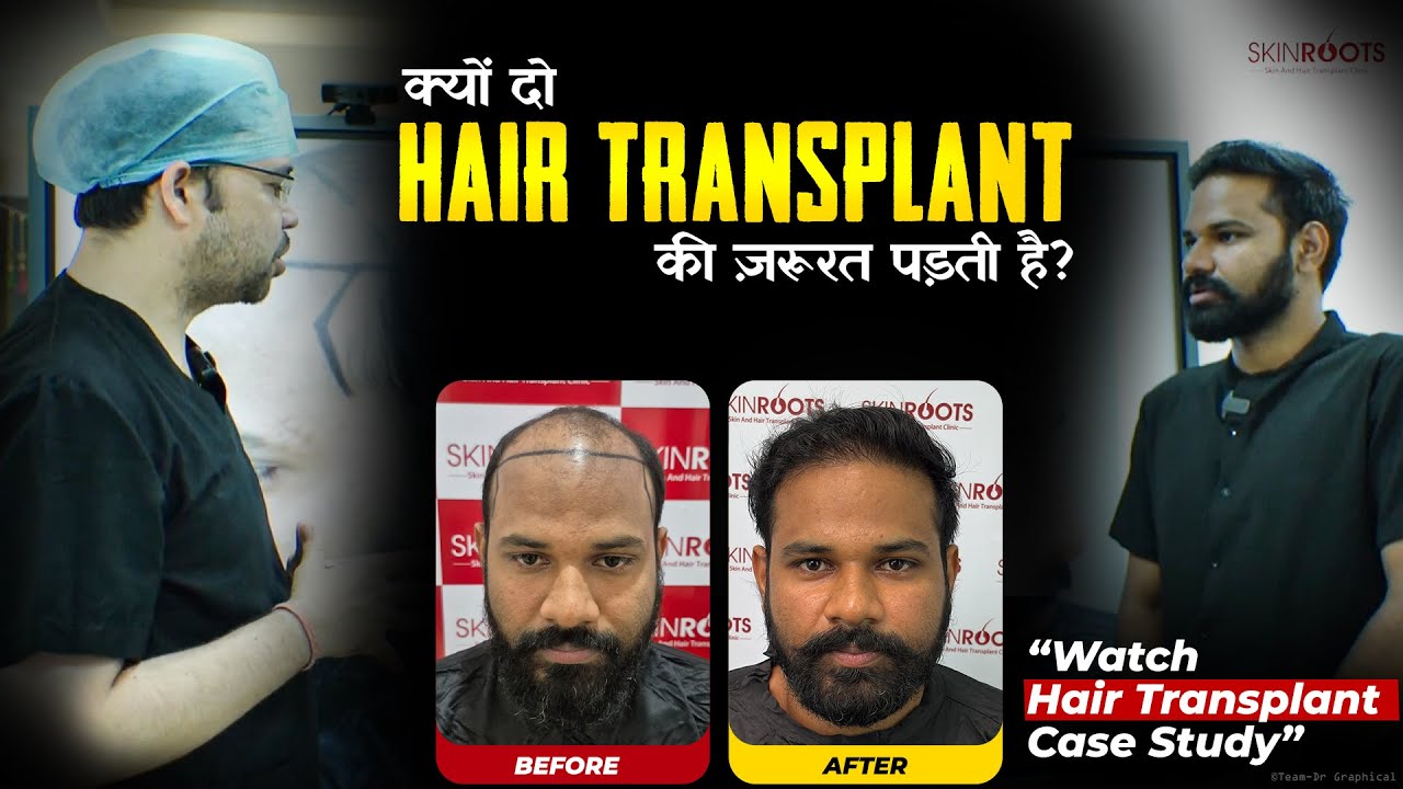 Crown Hair Transplant: When to Consider? | Grade 6 Baldness Permanent Solution |  Dr. Prakash Khute