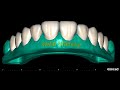 Mockup veneers full anatomy  tooth dental exocad  walid mansour 00201005587414 egypt cairo