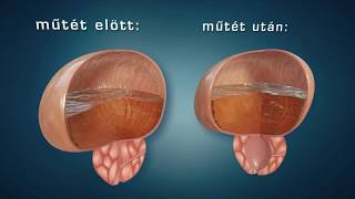 Prostatitis műtéti prostatitis cronica abacteriana duracion