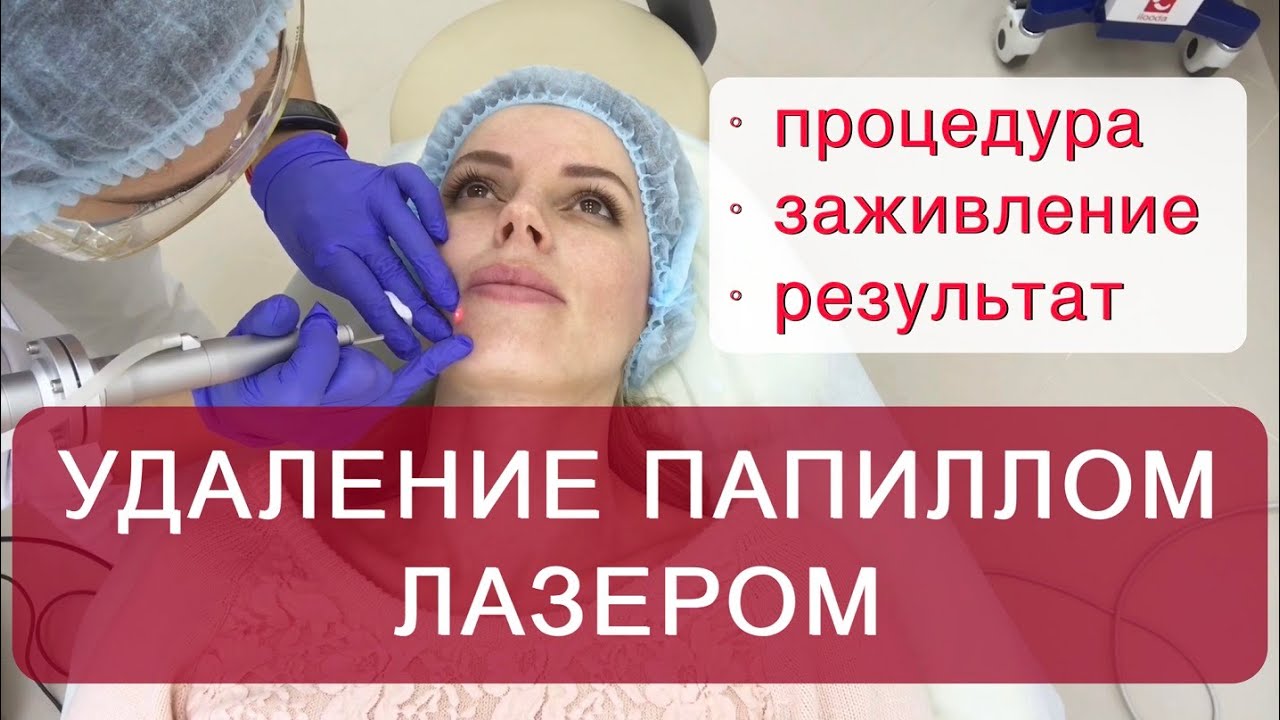 После Удаления Папиллом Можно Заниматься Сексом