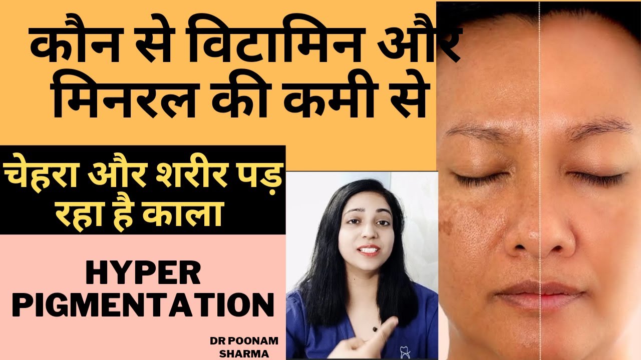 कौन  से विटामिन्स और मिनरल्स की कमी से स्किन काली पड़ती है ? How To Get Rid Of Hyperpigmentation
