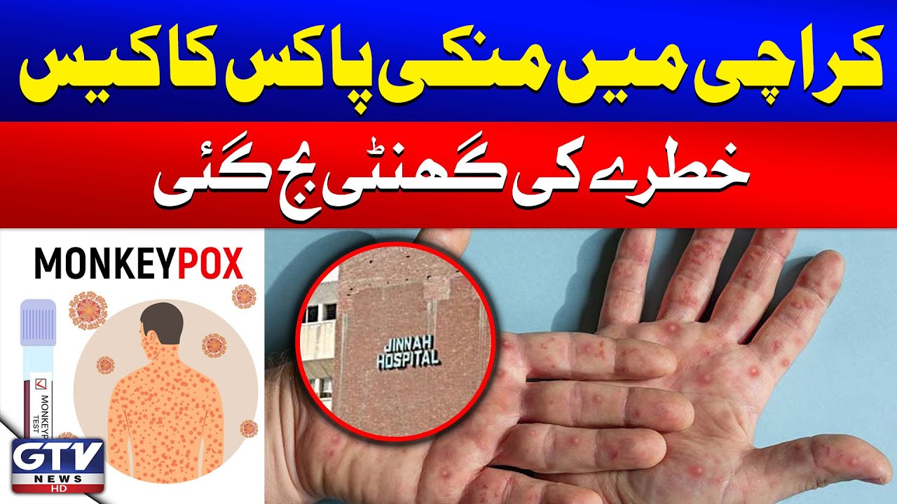 Monkeypox Case in Karachi | Latest Updates | Breaking News - YouTube