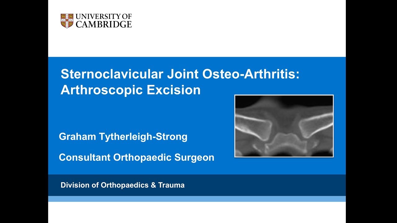 Sternoclavicular Joint Osteoarthritis Arthroscopic Management Youtube