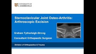 Sternoclavicular Joint Osteoarthritis: Arthroscopic Management