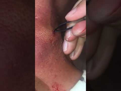 Neck cyst popped (/ The Sack!!!)