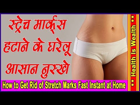 Image result wey dey for pregnancy stretch marks