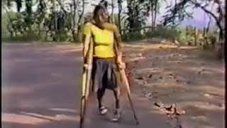 The Late Barbara Crutching With Her Polio Shortleg.