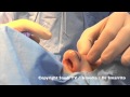Chirurgie esthetique par le docteur smarrito rhinoplastie augmentation mammaire liposuccion