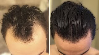 Back From The Dead Hair Loss Reversal In 6 Months