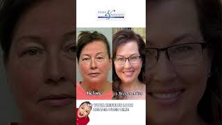 PDO Thread Lift Transformation | Non-Surgical Jawline Lift in Savannah, GA