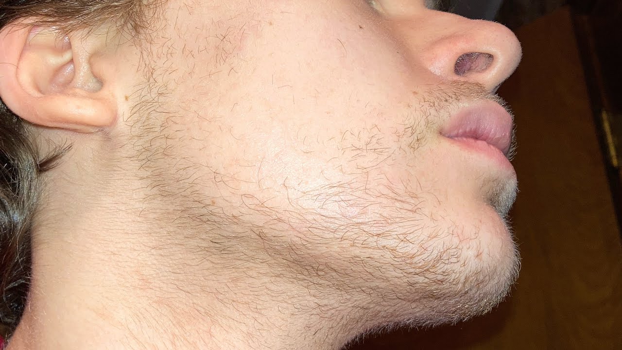 Minoxidil and Derma Roller (Week 26) (Month 6) - YouTube