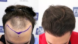 FUE Hair Transplant (2309 Grafts NW III A) By Dr Juan Couto - FUEXPERT CLINIC, Madrid, Spain