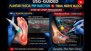 USG Guided PRP Injection for Chronic Plantar Fasciitis with tibial nerve block| Step-by-Step video