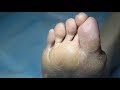 BEST MEDICAL PEDICURE --  foot scrubbing and foot soaking