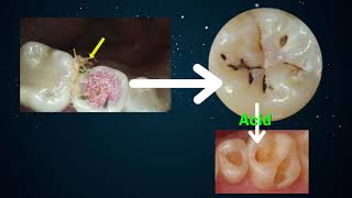 Dental Diseases and Prevention