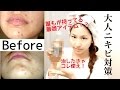 ニキビ対策スキンケア