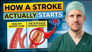 What a Stroke Looks Like the Day Before It Hits — Know This to Protect Yourself | Doctor Explains