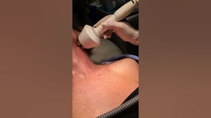 Radiofrequency Neck Lift Treatment