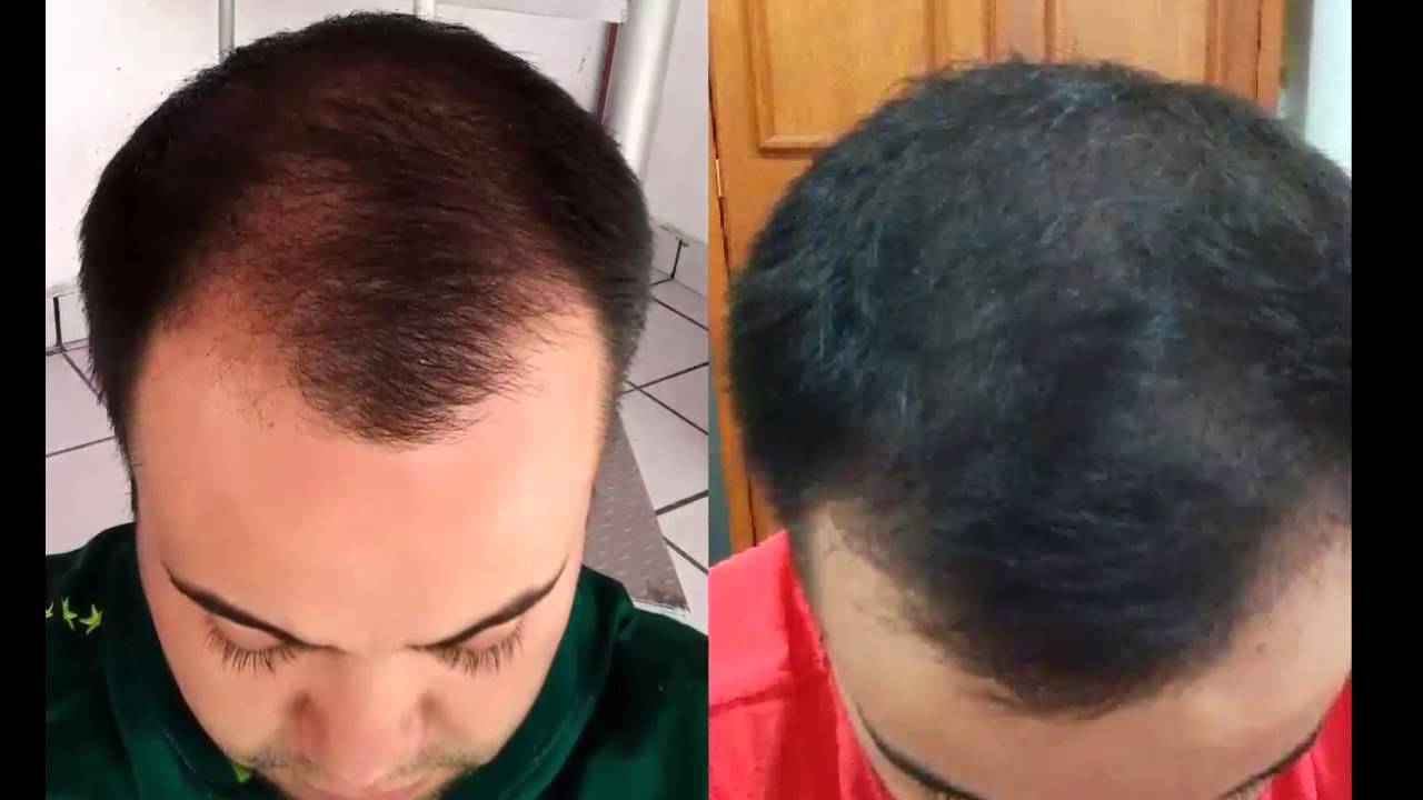 Shampoo folicure no funciona || Regenerador capilar rc Shampoo folicure no funciona || Regenerador capilar rc