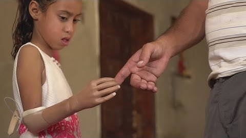 Jordan: How 3D printing is cutting the cost of prosthetics