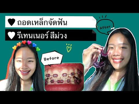 ถอดเหล็กจัดฟัน รีเทนเนอร์สีม่วง 3 ปี !!!! | ยุ้ยลี้ยุ้ย