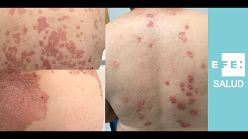 ¿Cuál es la mejor inyección para la psoriasis?