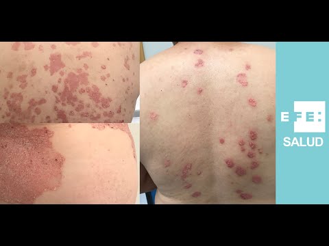 Video: 3 formas de aliviar los brotes de psoriasis