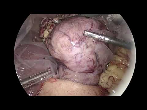 Giant Gastric GIST Laparoscopic excision 4 mins voice over