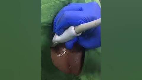 PECS 1 Block With Landmark Guided or LOR Technique: SIMPLIFYING NERVE BLOCKS (SNB) BLOCK 6