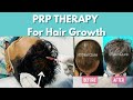 Prp therapy for hair loss shorts prp