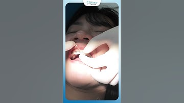 Đi Chun Chuỗi Trong Niềng Răng | Bác Sĩ Yên
