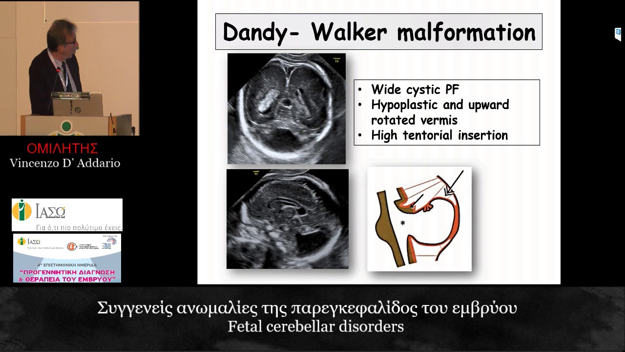 Συγγενείς ανωμαλίες της παρεγκεφαλίδος του εμβρύου -  Vincenzo D’ Addario