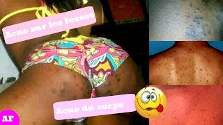 Est-ce que les poux font des boutons dans le cou ?