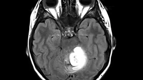 Pilocytic Astrocytoma