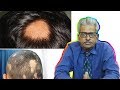 Alopecia Areata - Discussion and treatment in Homeopathy by Dr. P.S. Tiwari