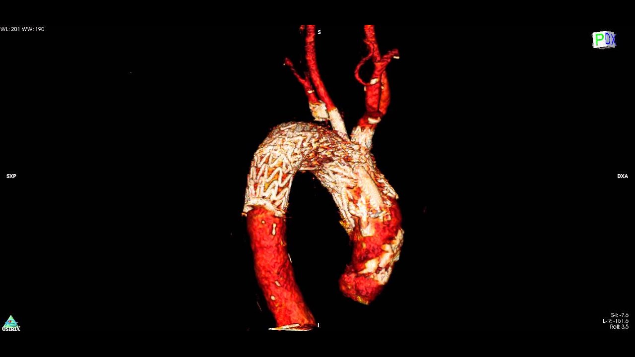 Aortic Arch total endovascular repair YouTube