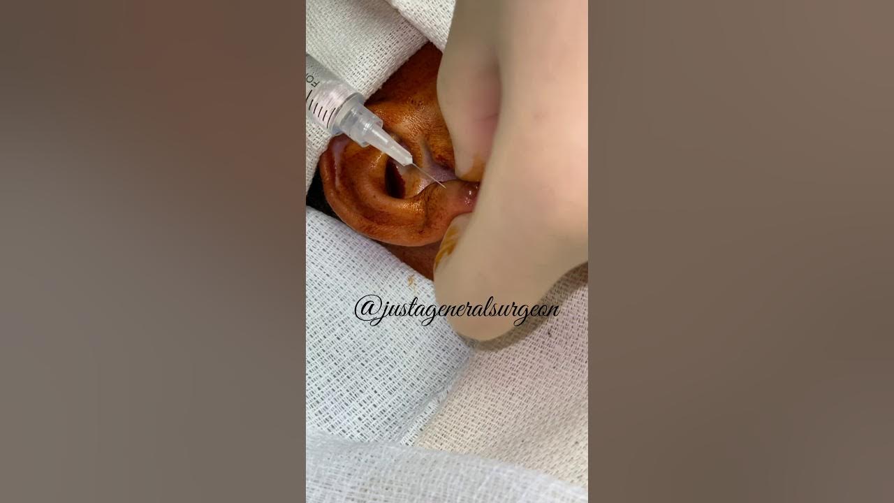 Inside the OR with justageneralsurgeon removal of embedded earring