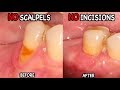 Gum Recession Causes & Treatment (The Pinhole Technique!)