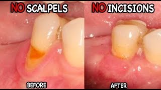 Gum Recession Causes & Treatment (The Pinhole Technique!)