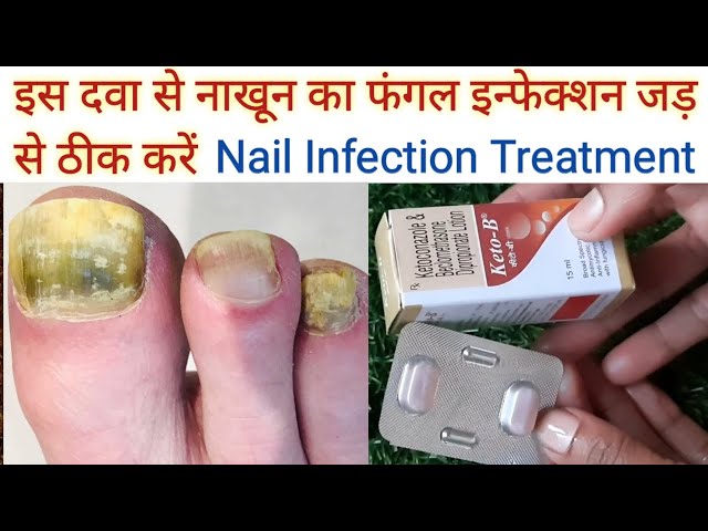 Newsio Nail Fungus Treatment Repair Foot Removal Toe Fungal Infection  Liquid for nails Price in India - Buy Newsio Nail Fungus Treatment Repair  Foot Removal Toe Fungal Infection Liquid for nails online