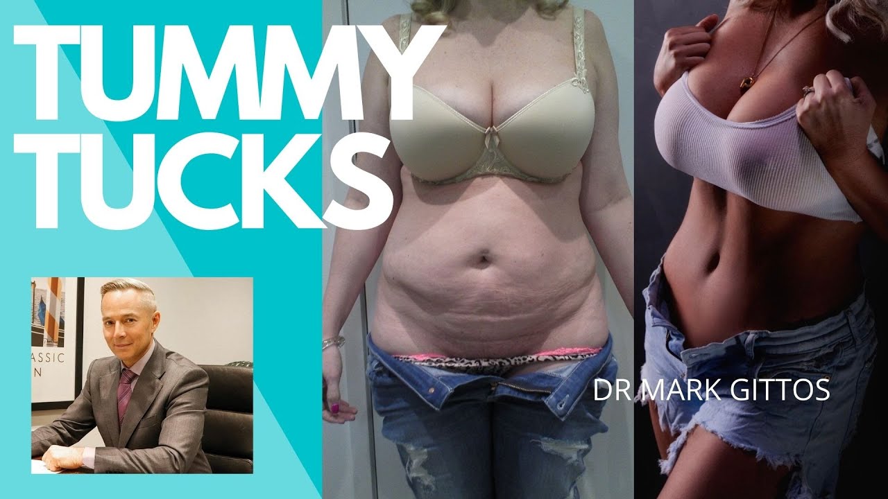 tummy tuck trip meaning