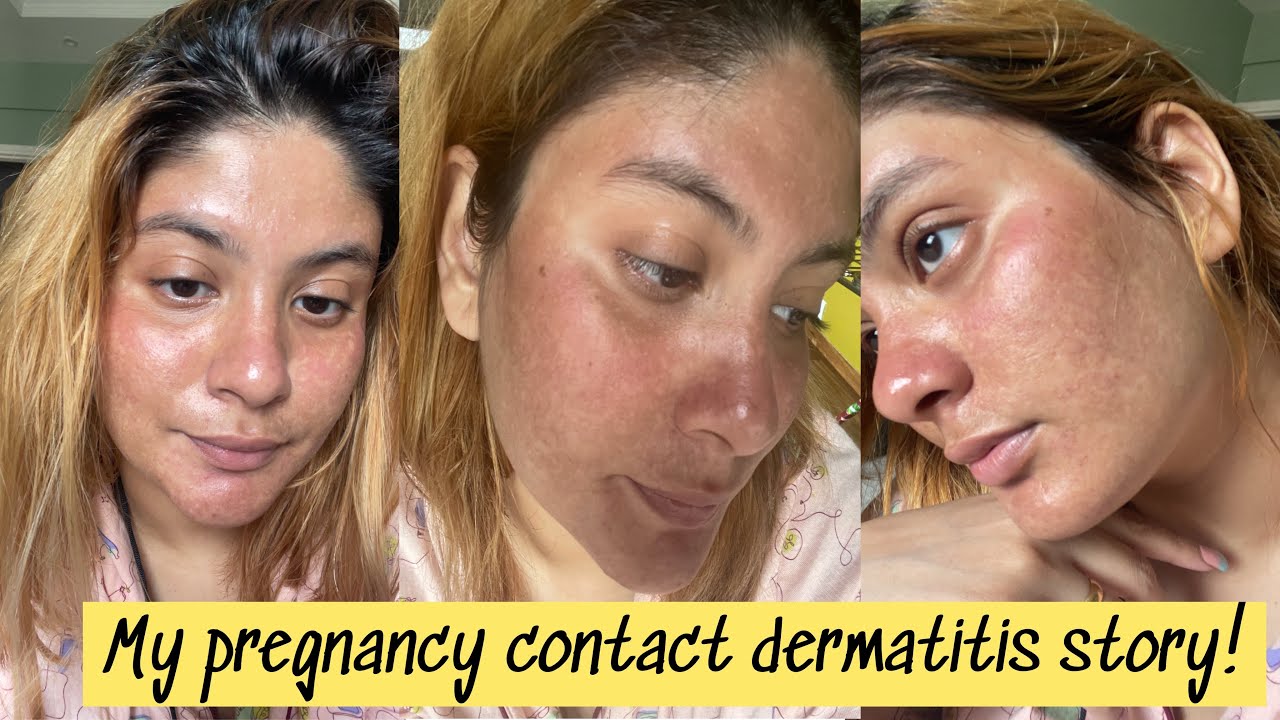 MY PREGNANCY CONTACT DERMATITIS STORY+ MINI HAUL YouTube