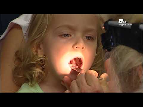 Video: Muss Das Kind Polypen Entfernen?