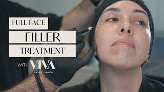 Full Face Filler Treatment - How to Lift and Contour with Dermal Fillers | 2023