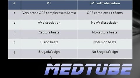 VT vs. SVT with aberrancy Made Easy