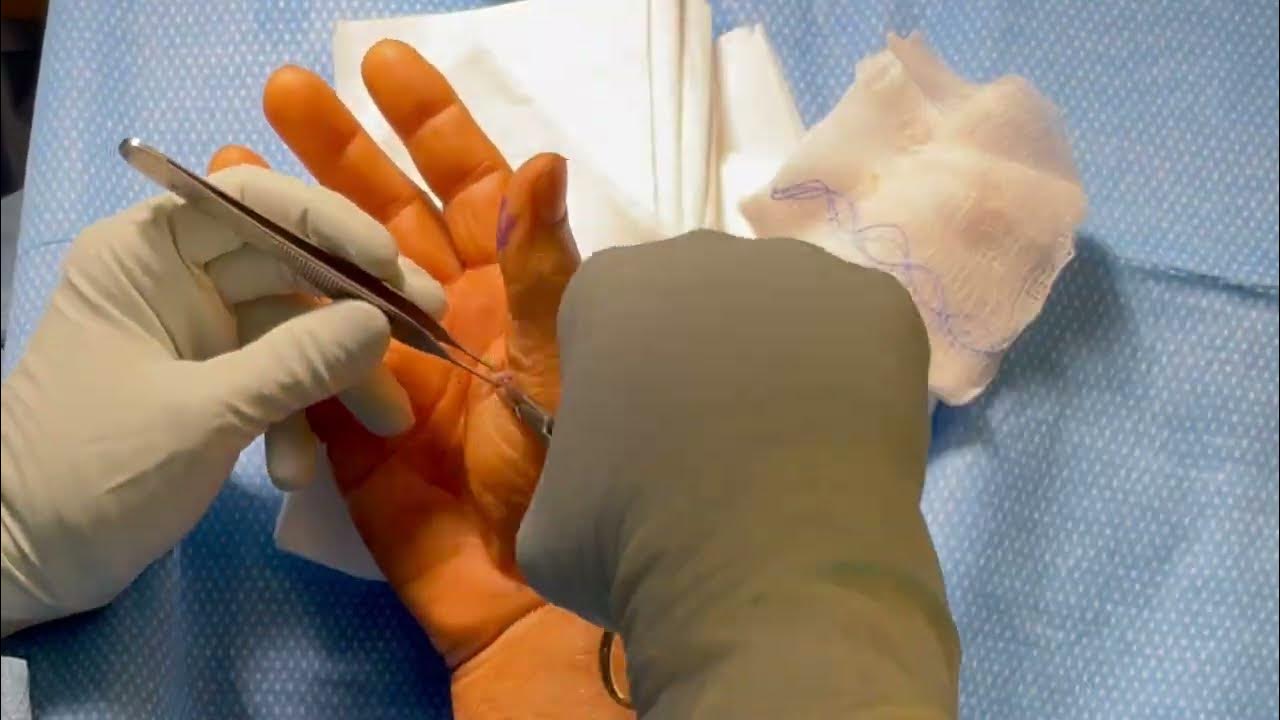 Right Trigger Thumb Release Surgery trigger Finger YouTube right-trigger-thumb-release-surgery-trigger-finger-youtube