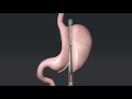 Animation of sleeve gastrectomy with titan sgs