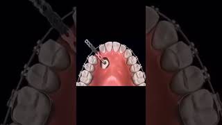 Impacted Canine Retraction