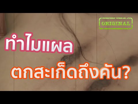 ทำไมแผลตกสะเก็ดถึงคัน? | รู้หรือไม่ - DYK