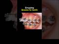 Amazing braces. can fix all problem teeth #braces #orthodontist #dentist